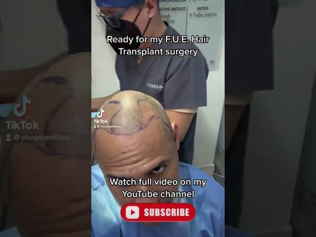 FUE Hair Transplant. #fuehairtransplant #beforeandafter #result #surgeryrecovery #surgeryvlog #tj