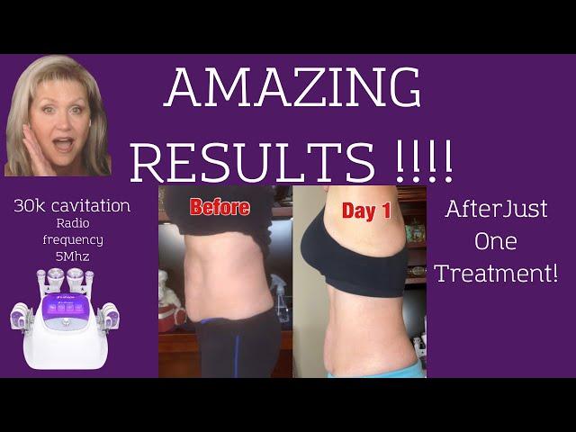 S-Shape Pro  |  ZAP YOUR FAT with at home CAVITATION & RADIO FREQUENCY SKIN TIGHTENING