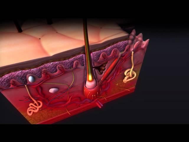 Unveiling Psoriasis: An Animated Dive into the World of Skin’s Silent Struggle