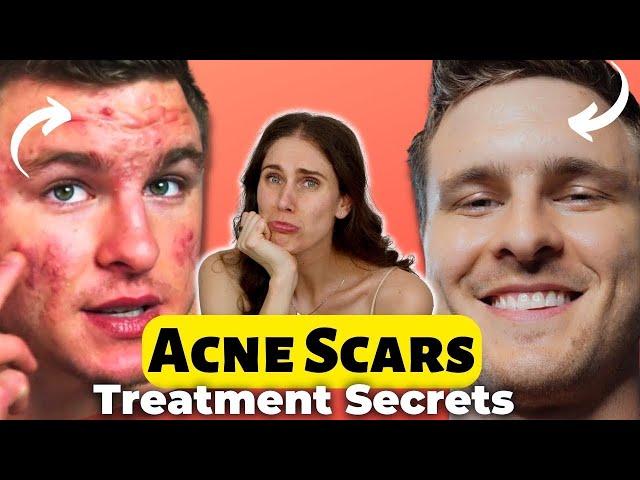 1 Thing That Cleared His Severe Cystic Acne Scarring - Microneedling?! Brian Turner From TeamAcne