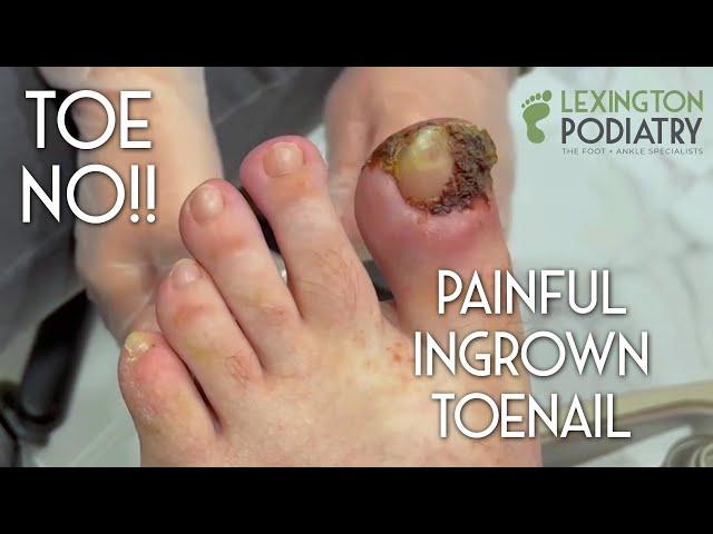 TOE NO!! Painful Ingrown Toenail Removal