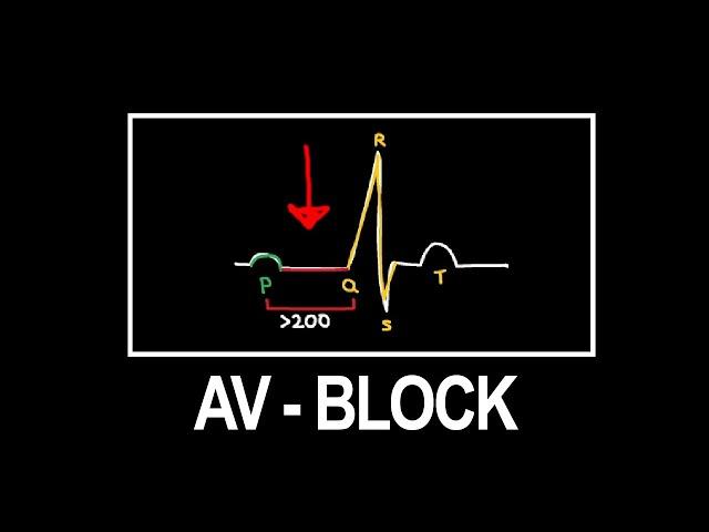 AV BLOCK: einfache Merkhilfen