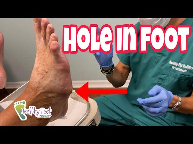 ANOTHER DIABETIC FOOT CATASTROPHE AND BONUS DIABETIC FOOT CARE TIPS