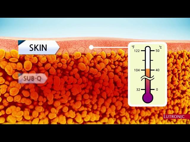 enCurve How Does Radio Frequency Fat Removal Work