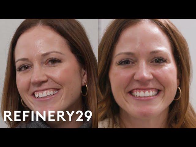 I Got Porcelain Restoration Veneers For The First Time | Macro Beauty | Refinery29