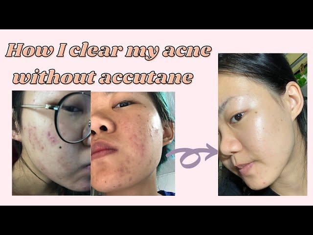 How I got rid of my Cystic Acne & pimples with Eighteen Vitaskin Supplement (without Accutane)