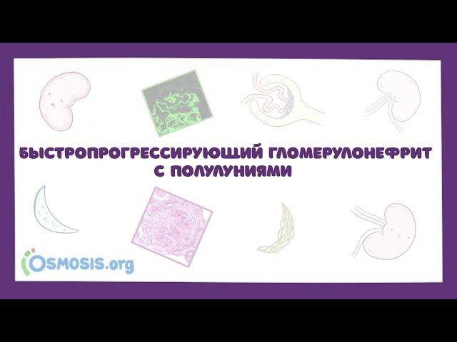 Быстропрогрессирующий гломерулонефрит с полулуниями - причины, симптомы, лечение (лекция)