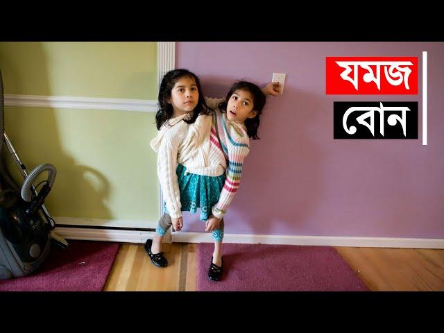 দুই বোন এক দেহে যমজ | জোড়া মানুষ | strange people | Conjoined Twins