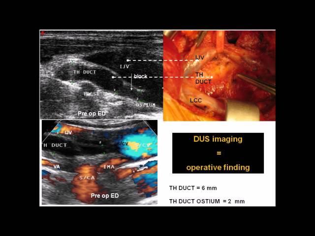 Thoracic duct end obstruction - By Claude Franceschi