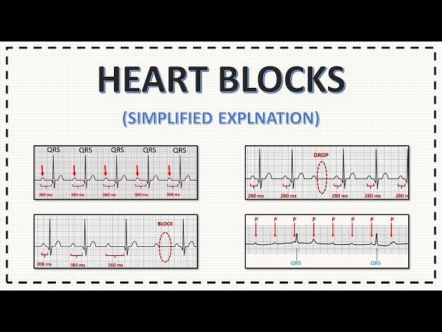 Heart Blocks ECG | AV Blocks ECG | Simplified Explanation with Examples