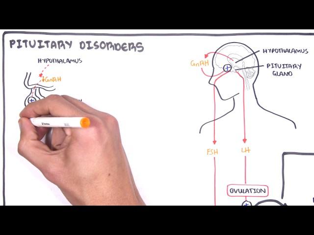 Gynaecology - Infertility in Women (causes and pathophysiology)