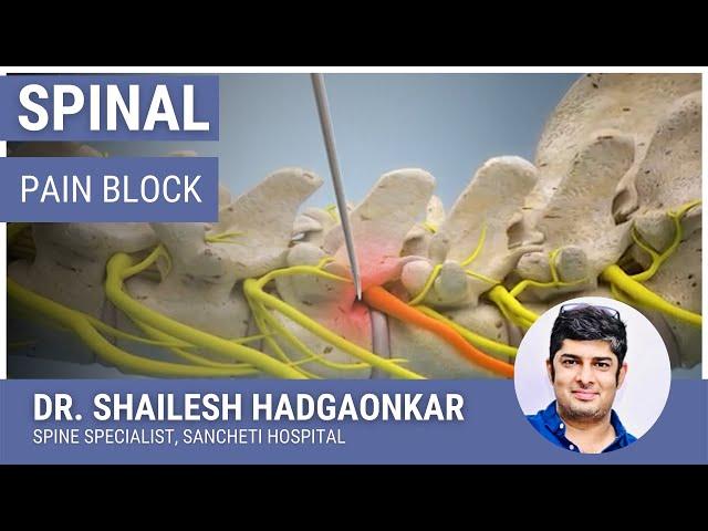 स्पायनल पेन ब्लॉक - जाणिये आखिर क्या होता है? स्पाईन इंजेक्शन | SPINE Pain Block Injection