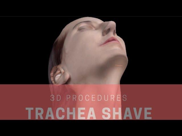 Adam´s Apple Reduction / Trachea Shave feminization in 3-D | FACIALTEAM