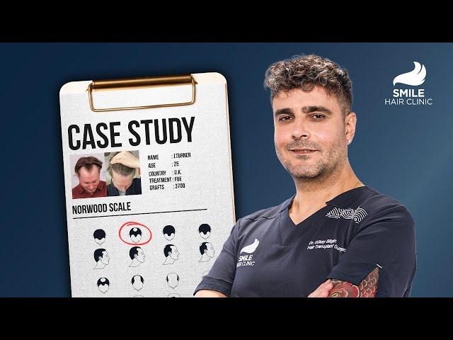 3700 Grafts Hair Transplant | 12-Month Results with Dr. Bilgin | Case Study