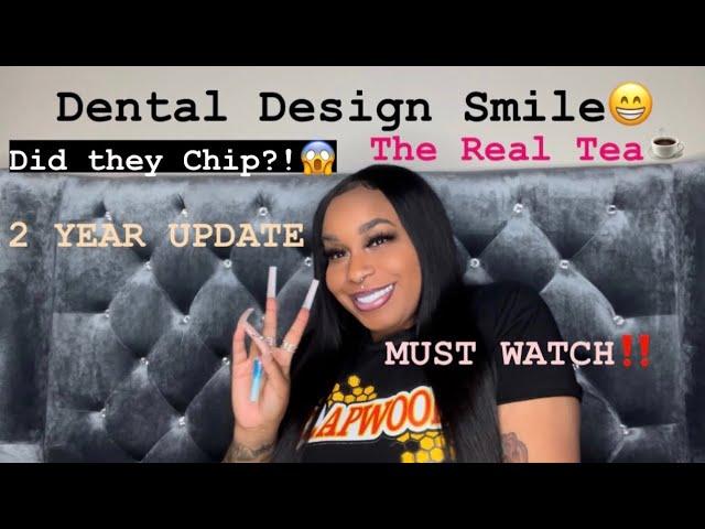 Dental Design Smile 2 Year Update Composite resin Veneers - @queenenvi ￼