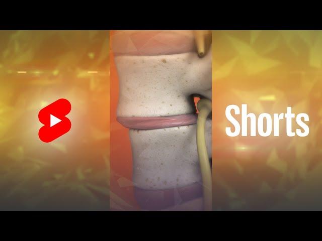 What is Spondylolisthesis? | Vertebral Slippage #Shorts