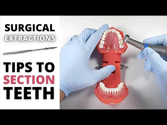 SURGICAL EXTRACTION SECTIONING TIPS | OnlineExodontia.com