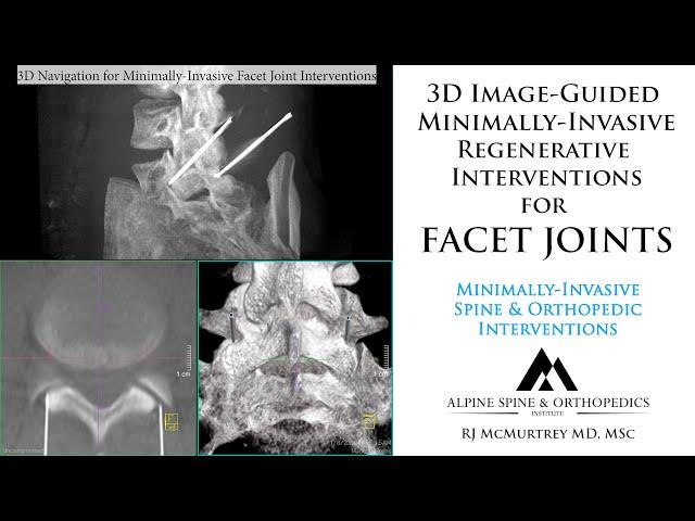 Facet Joint Arthritis of the Spine: Minimally-Invasive Regenerative Injections with 3D Guidance