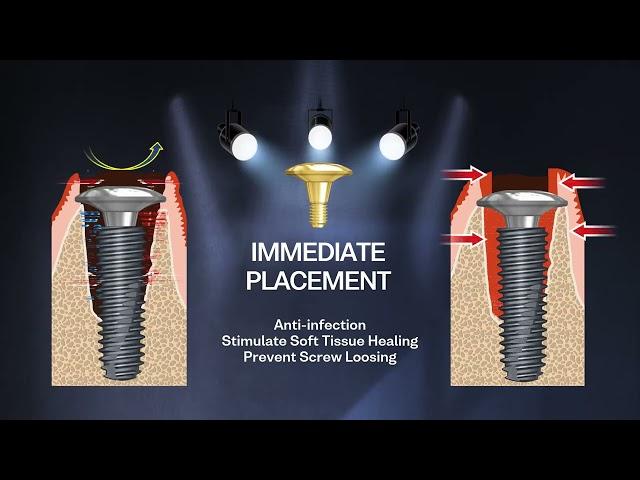 New Implant Screw  BIOARK by BIOTEM. Expert of Implant