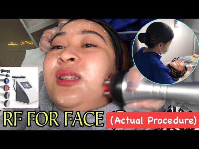 RF FOR FACE (RADIOFREQUENCY - ACTUAL PROCEDURE!)