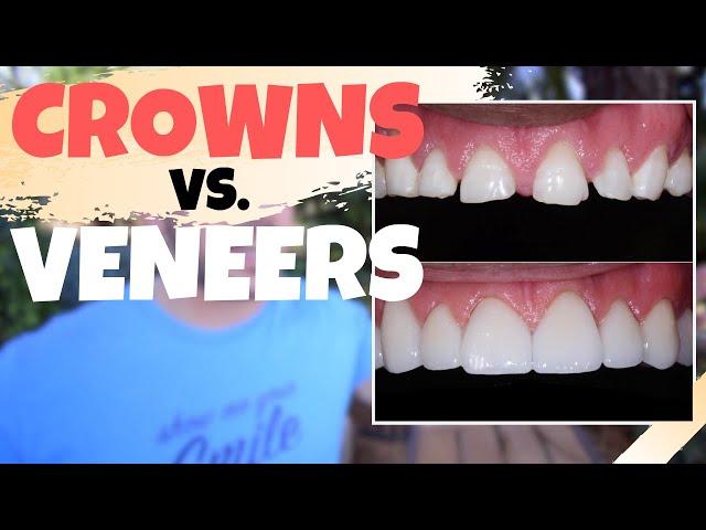 Dental CROWNS vs. Porcelain VENEERS | Is the Dental Veneers Procedure Worth It?!?