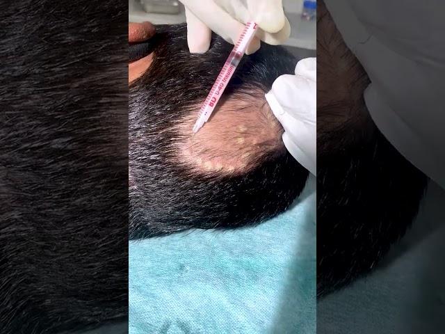 Alopecia Areata Treatment For Hair Growth | Treatment Of Alopecia | Skinaa Clinic #shorts #viral