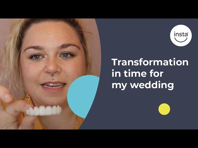 Wedding Smile Transformation | Clip On Veneers | Instasmile Review