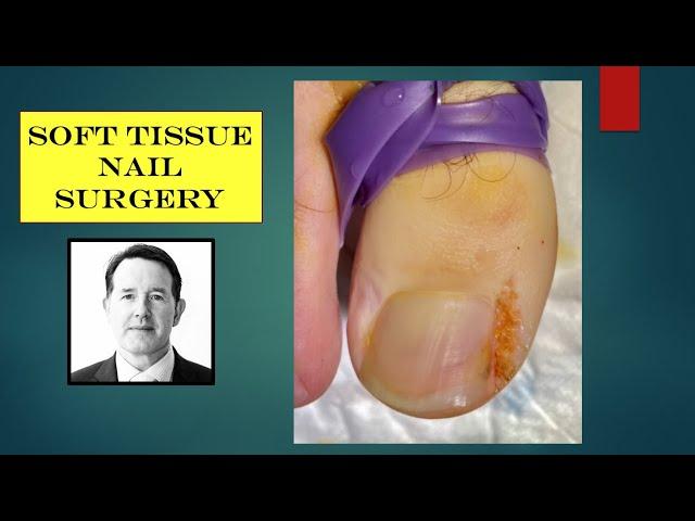 Video - soft tissue nail procedure