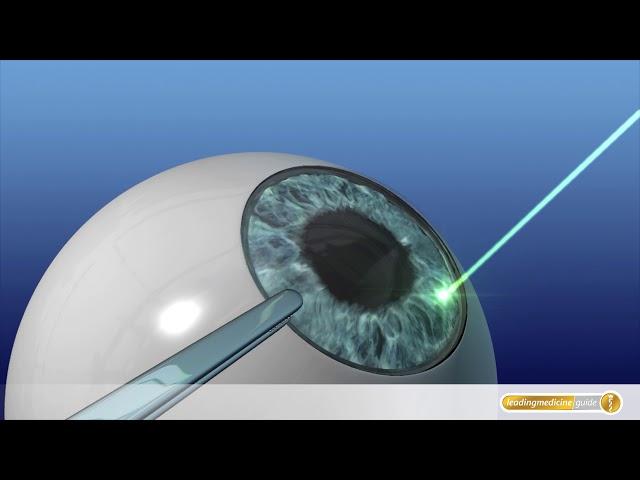 Augen-OP mit Laser: So funktioniert LASIK