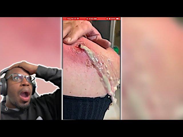 REACTING To Popping HUGE Blackheads and Pimple Popping | Best Pimple Popping Videos 83