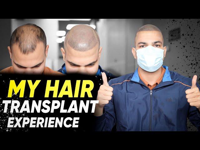 Hair Transplant in Bhopal | Best Results & Cost of Hair Transplant in Bhopal