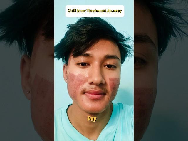 Co2 laser Treatment Journey || Acne Scar,Cut Mark Solution #laser #acnescars