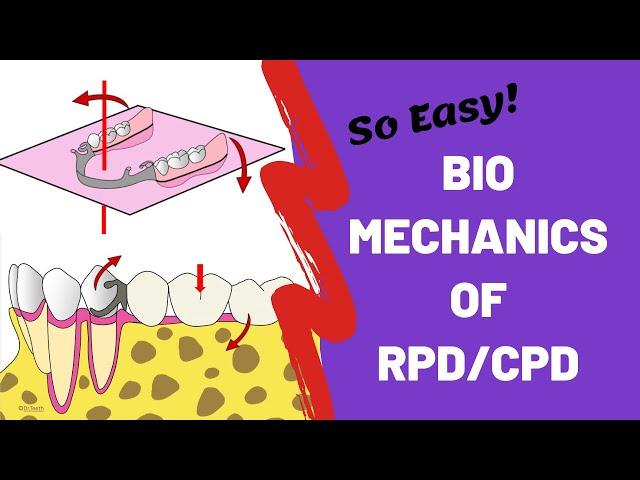 Biomechanics of Removable Partial Dentures | Prosthodontics