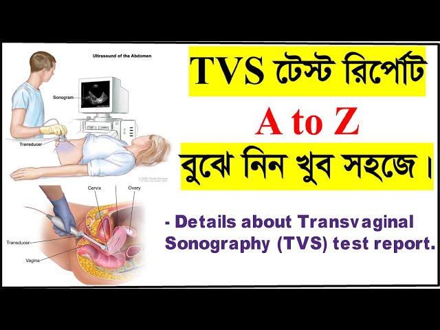 TVS টেস্ট রির্পোট বুঝার সহজ উপায়। How to read Transvaginal ultrasound or TVS test report? TVS test