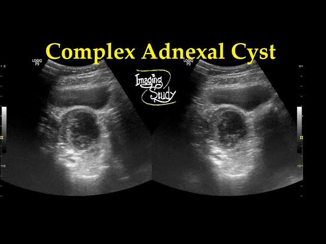 Complex Adnexal Cyst || Ultrasound || Case 27