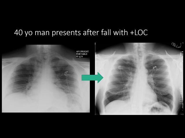 Enlargement of the Mediastinum