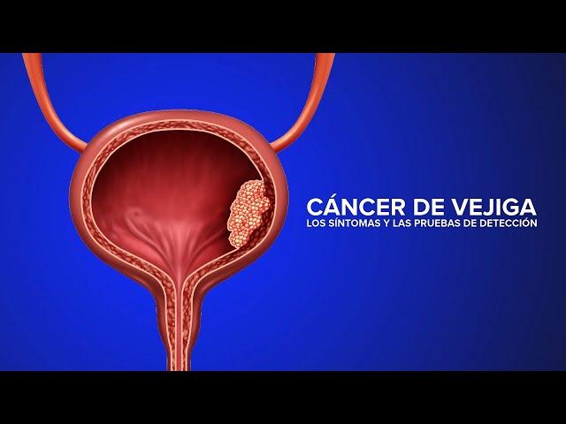 Cáncer de Vejiga - Los síntomas y las pruebas de detección