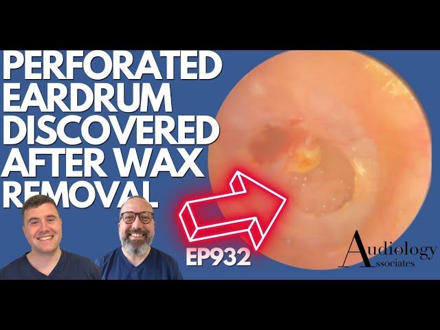 PERFORATED EARDRUM DISCOVERED AFTER EAR WAX REMOVAL - EP932