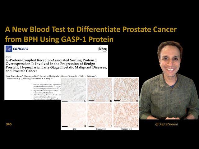 A New Blood Test to Differentiate Prostate Cancer from BPH Using GASP-1 Protein