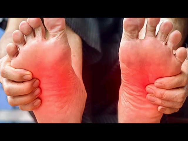 ERITROMELALGIA Dolor y ardor en los pies  pies calientes DOLOR DE PIES