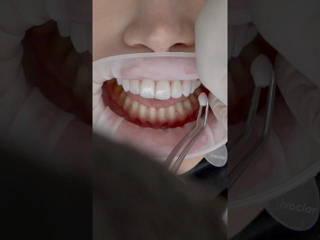 Incredible transformation with Porcelain Veneers!! #Dentalveneers #asmr #cosmeticdentistry