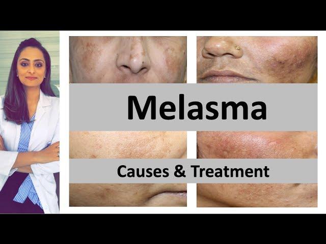 How to treat dark spots | Melasma | Causes & treatment | Dermatologist | Dr. Aanchal Panth