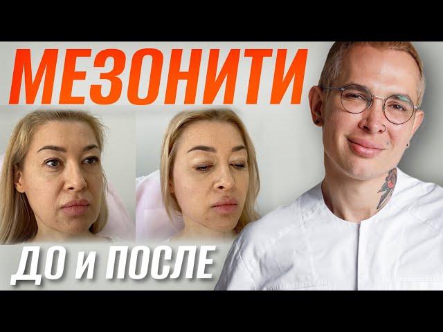 МЕЗОНИТИ ДО и ПОСЛЕ | Ставим Нити COG, мгновенная подтяжка лица #мезонити #подтяжкалица