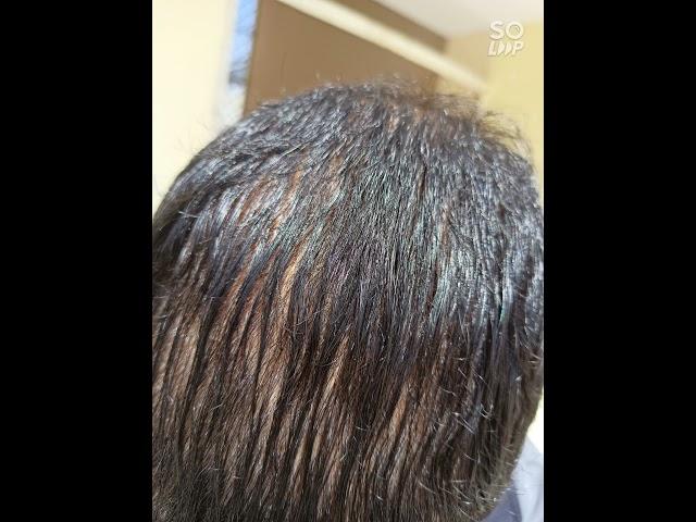 Medispa  failed hair transplant