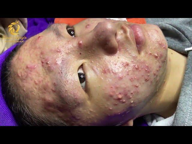 Treatment of acne tablets, pustules and blackheads (358) | Loan Nguyen