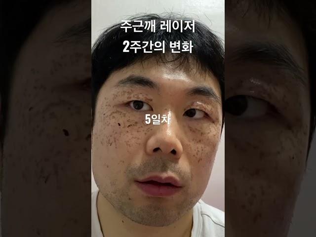 주근깨 레이저 2주간의 변화 #주근깨 #레이저