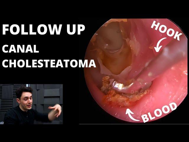 FOLLOW UP: Canal Cholesteatoma Patient Is Back