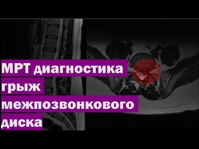 МРТ диагностика грыж межпозвонкового диска | Как выглядит грыжа на МРТ