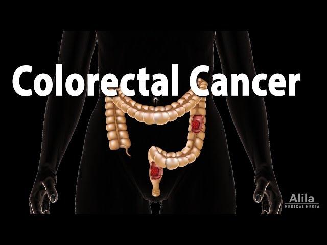 Colon Cancer: Pathology, Symptoms, Screening, Cause and Risk Factors, Animation