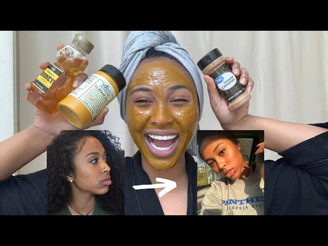 How to get rid of dark spots/acne scars OVERNIGHT!